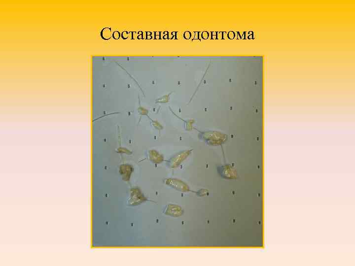 Составная одонтома 