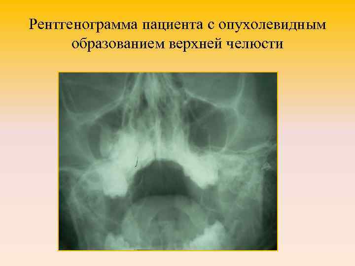 Рентгенограмма пациента с опухолевидным образованием верхней челюсти 