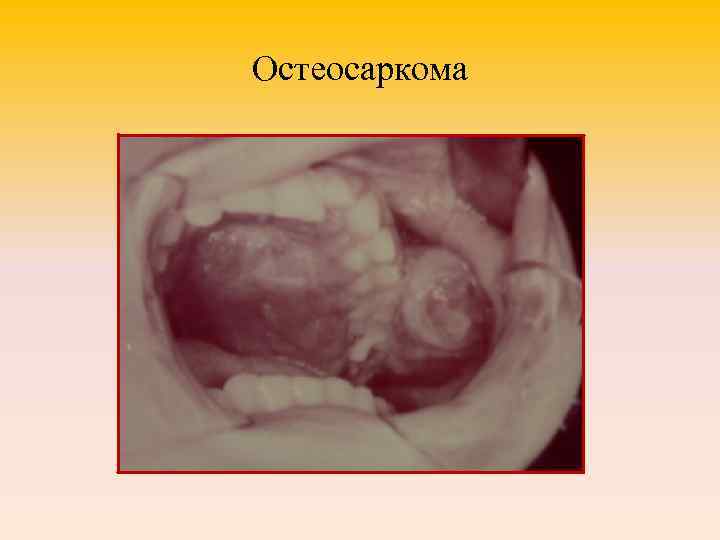 Остеосаркома 