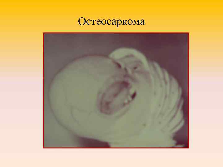 Остеосаркома 
