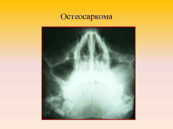 Остеосаркома 