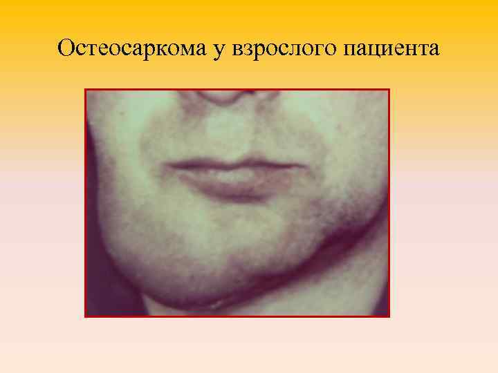 Остеосаркома у взрослого пациента 