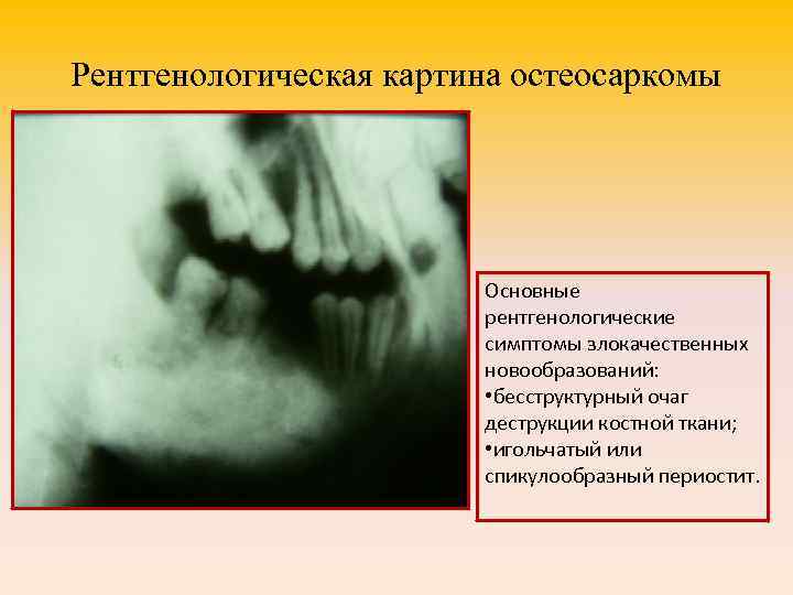 Рентгенологическая картина остеосаркомы Основные рентгенологические симптомы злокачественных новообразований: • бесструктурный очаг деструкции костной ткани;