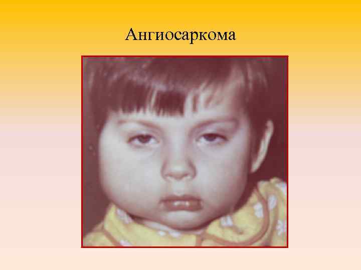 Ангиосаркома 