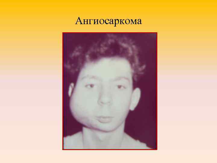 Ангиосаркома 
