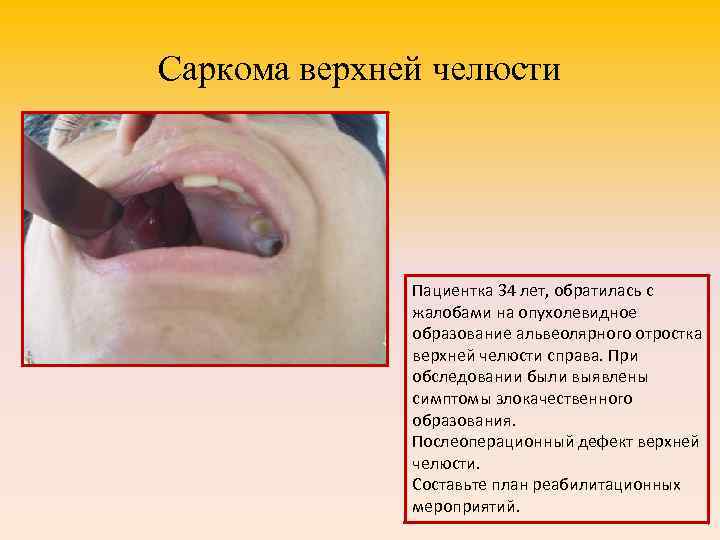 Саркома верхней челюсти Пациентка 34 лет, обратилась с жалобами на опухолевидное образование альвеолярного отростка
