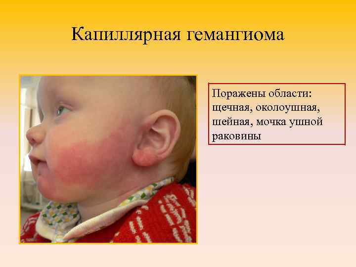 Капиллярная гемангиома Поражены области: щечная, околоушная, шейная, мочка ушной раковины 