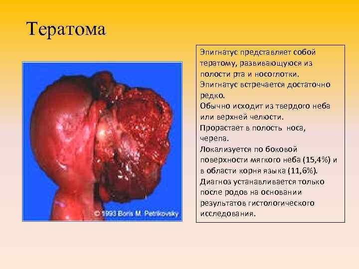 Тератома Эпигнатус представляет собой тератому, развивающуюся из полости рта и носоглотки. Эпигнатус встречается достаточно