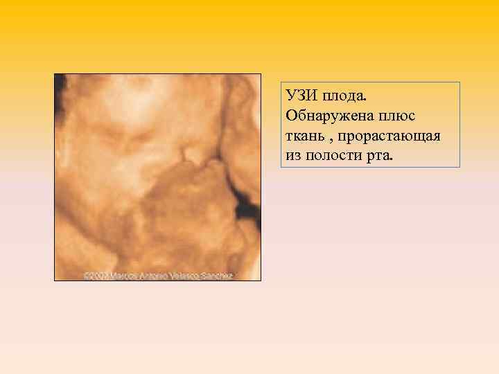 УЗИ плода. Обнаружена плюс ткань , прорастающая из полости рта. 