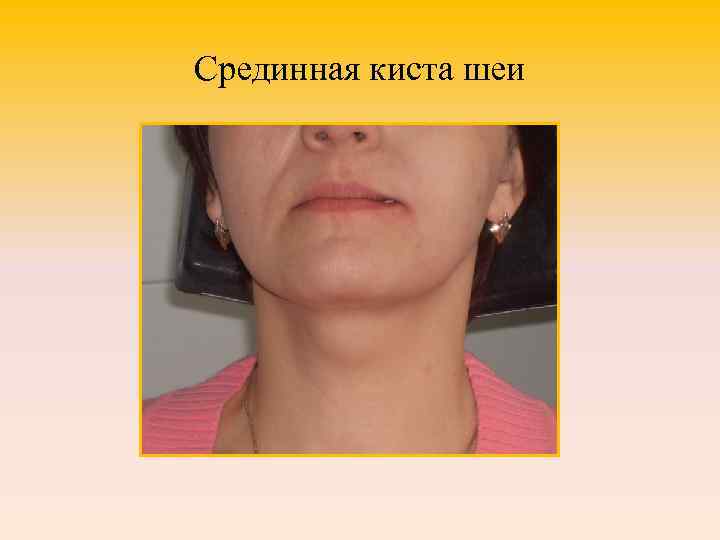 Срединная киста шеи 