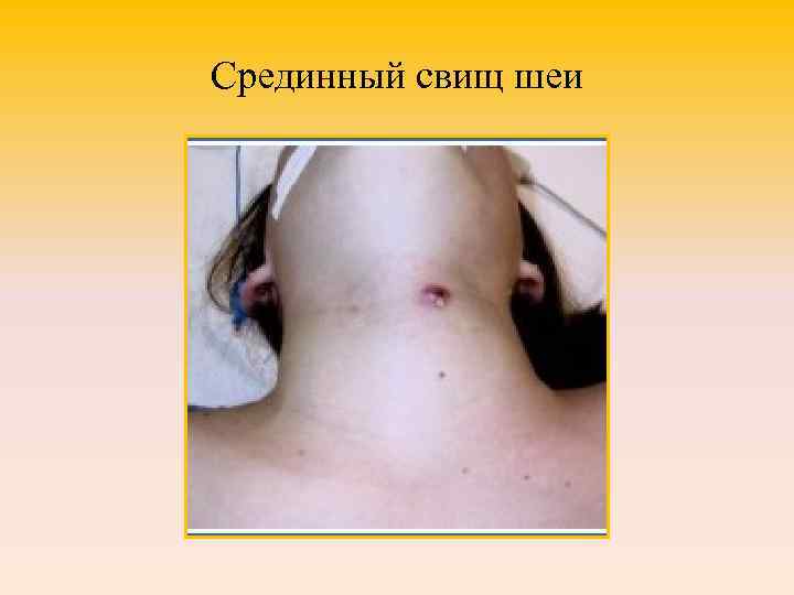 Срединный свищ шеи 