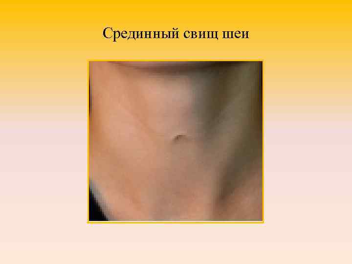 Срединный свищ шеи 