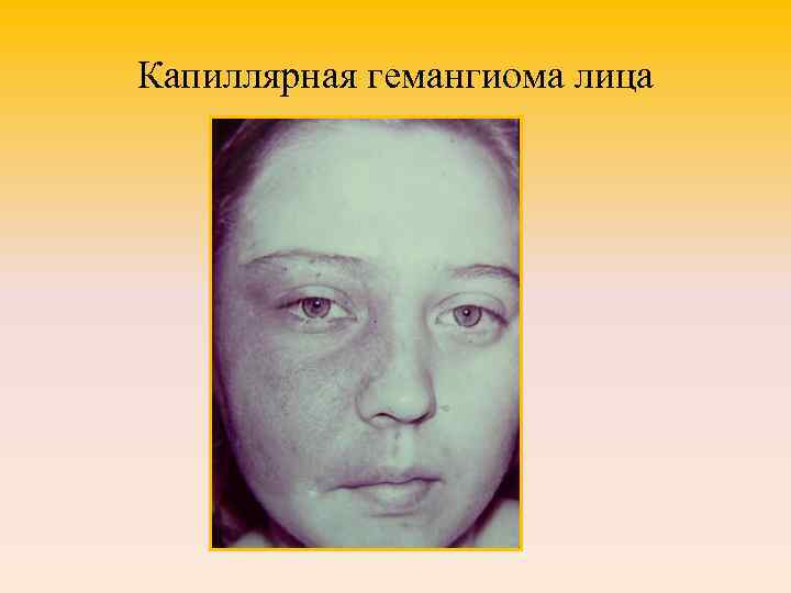 Капиллярная гемангиома лица 