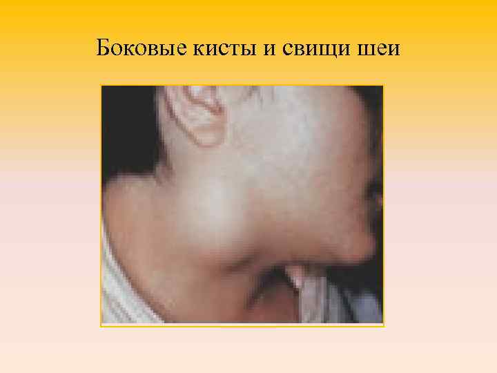 Боковые кисты и свищи шеи 