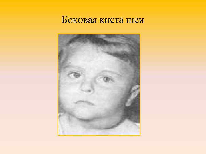 Боковая киста шеи 