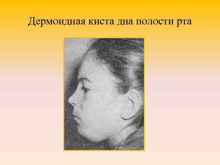 Дермоидная киста дна полости рта 