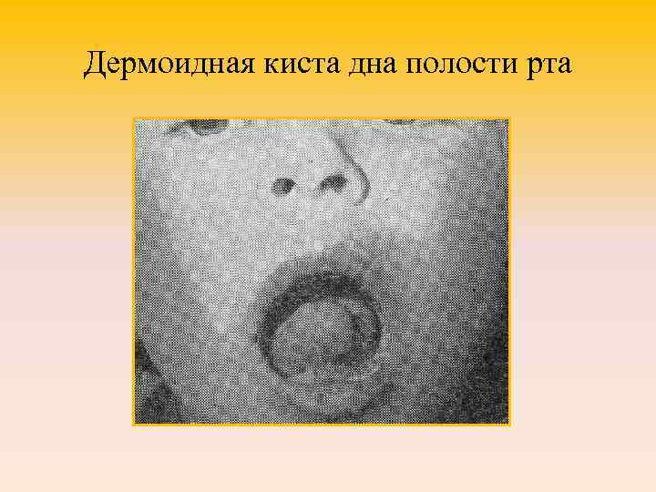 Дермоидная киста дна полости рта 