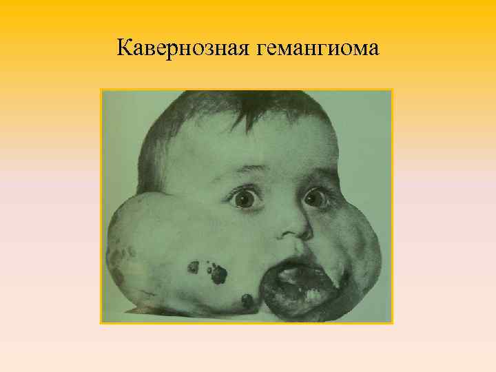 Кавернозная гемангиома 
