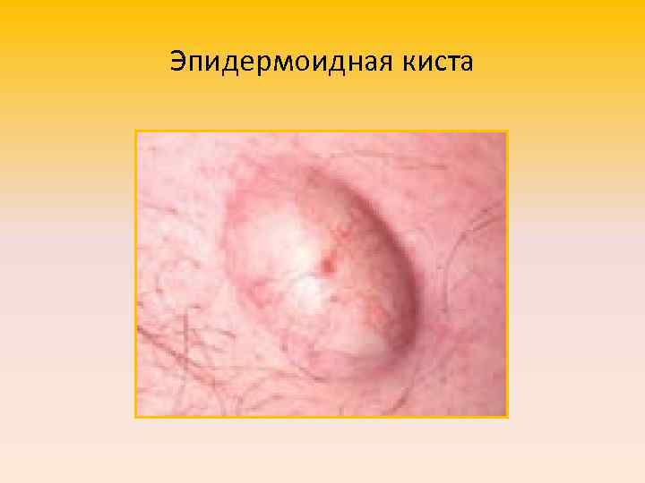 Эпидермоидная киста 