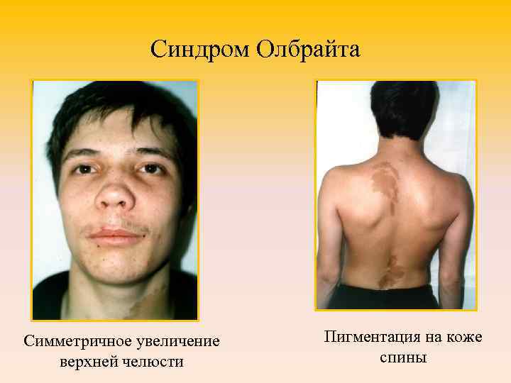 Синдром Олбрайта Симметричное увеличение верхней челюсти Пигментация на коже спины 