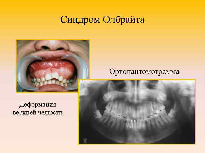 Синдром Олбрайта Ортопантомограмма Деформация верхней челюсти 
