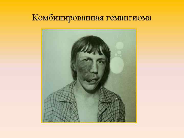 Комбинированная гемангиома 