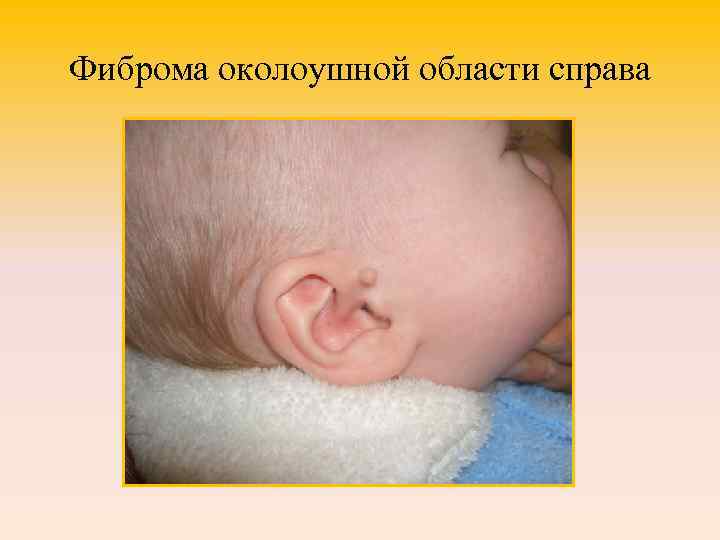 Фиброма околоушной области справа 