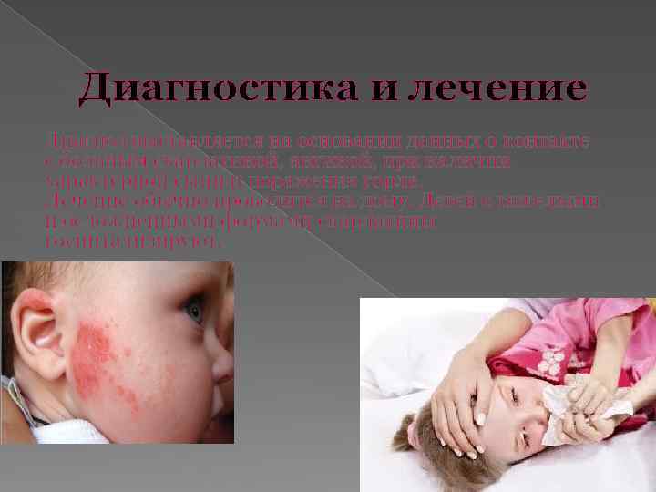 Диагностика и лечение Диагноз выставляется на основании данных о контакте с больным скарлатиной, ангиной,