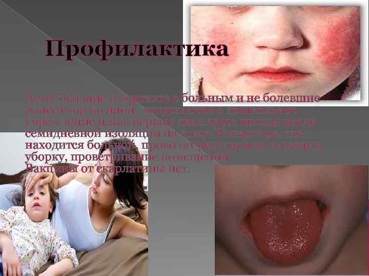 Профилактика Дети, бывшие в контакте с больным и не болевшие ранее скарлатиной, допускаются в