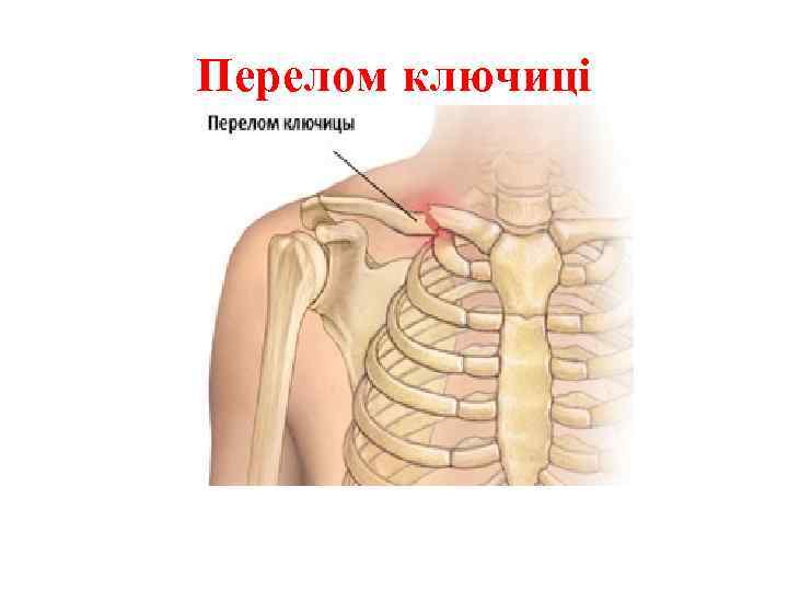 Перелом ключиці 