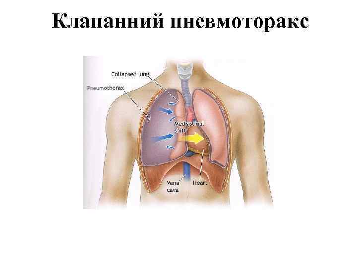 Клапанний пневмоторакс 