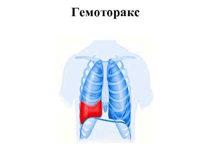 Гемоторакс Оксигенотерапия 