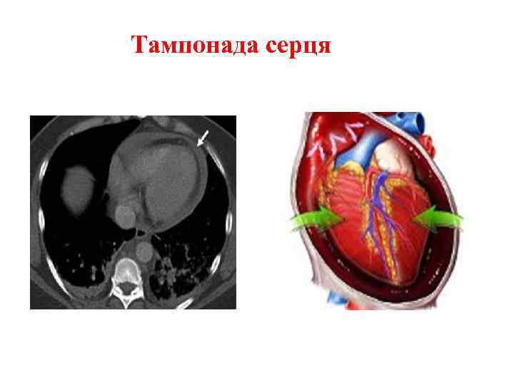 Тампонада серця 