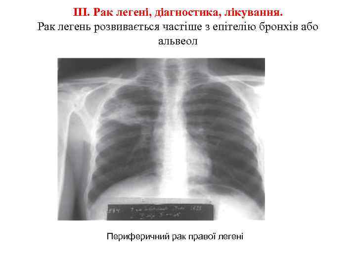 ІІІ. Рак легені, діагностика, лікування. Рак легень розвивається частіше з епітелію бронхів або альвеол