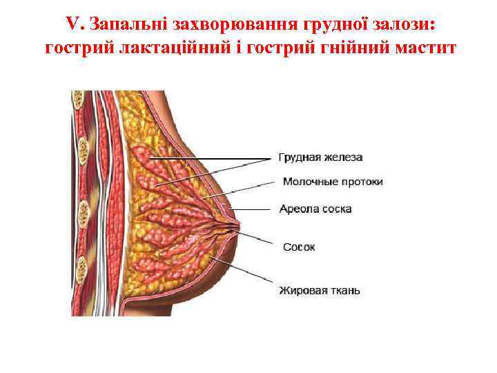 V. Запальні захворювання грудної залози: гострий лактаційний і гострий гнійний мастит 