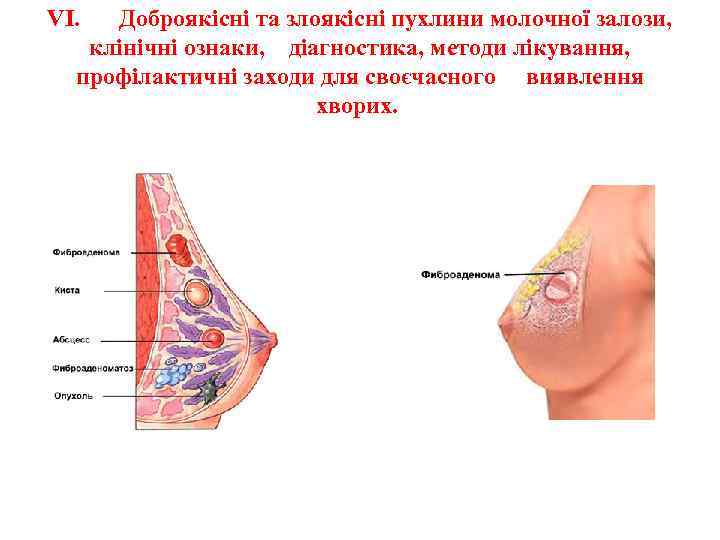 VІ. Доброякісні та злоякісні пухлини молочної залози, клінічні ознаки, діагностика, методи лікування, профілактичні заходи