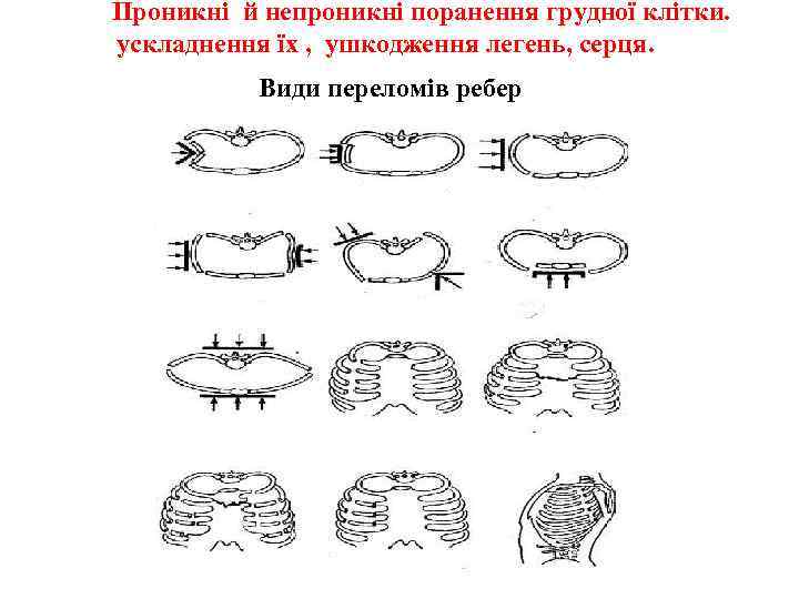 Проникні й непроникні поранення грудної клітки. ускладнення їх , ушкодження легень, серця. Види переломів