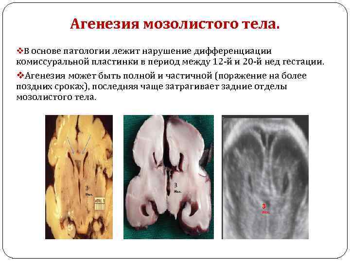 Агенезия мозолистого тела. v. В основе патологии лежит нарушение дифференциации комиссуральной пластинки в период