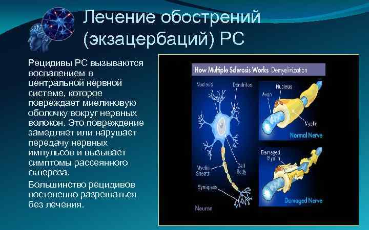 Лечение обострений (экзацербаций) РС Рецидивы РС вызываются воспалением в центральной нервной системе, которое повреждает
