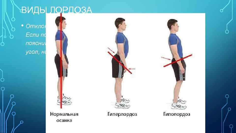 ВИДЫ ЛОРДОЗА • Отклонение в ту или иную сторону считается патологией. Если позвоночник оказывается