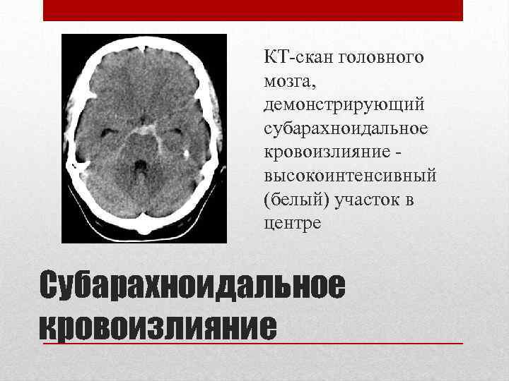 КТ-скан головного мозга, демонстрирующий субарахноидальное кровоизлияние - высокоинтенсивный (белый) участок в центре Субарахноидальное кровоизлияние