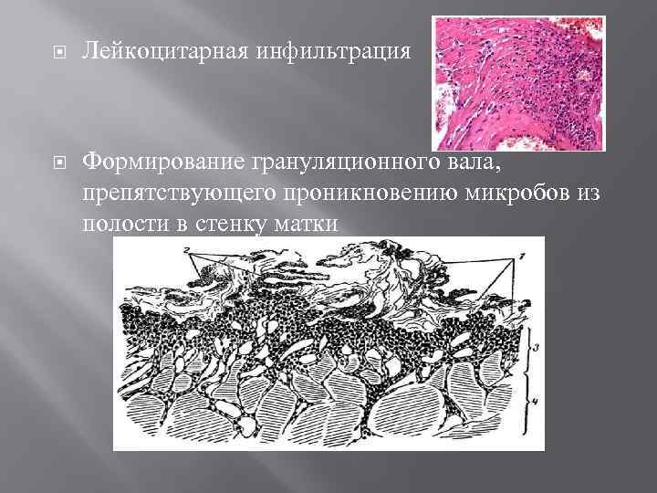  Лейкоцитарная инфильтрация Формирование грануляционного вала, препятствующего проникновению микробов из полости в стенку матки