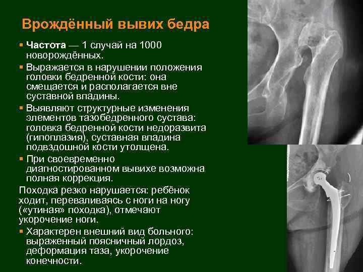 Врождённый вывих бедра § Частота — 1 случай на 1000 новорождённых. § Выражается в