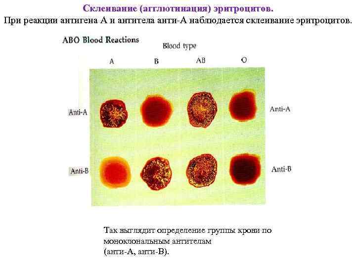 Cклеивание (агглютинация) эритроцитов. При реакции антигена A и антитела анти-А наблюдается склеивание эритроцитов. Так