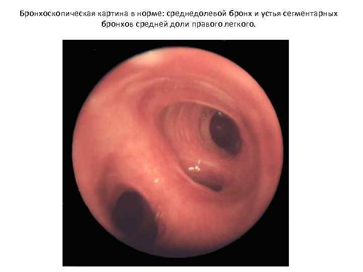 Бронхоскопическая картина в норме: среднедолевой бронх и устья сегментарных бронхов средней доли правого легкого.