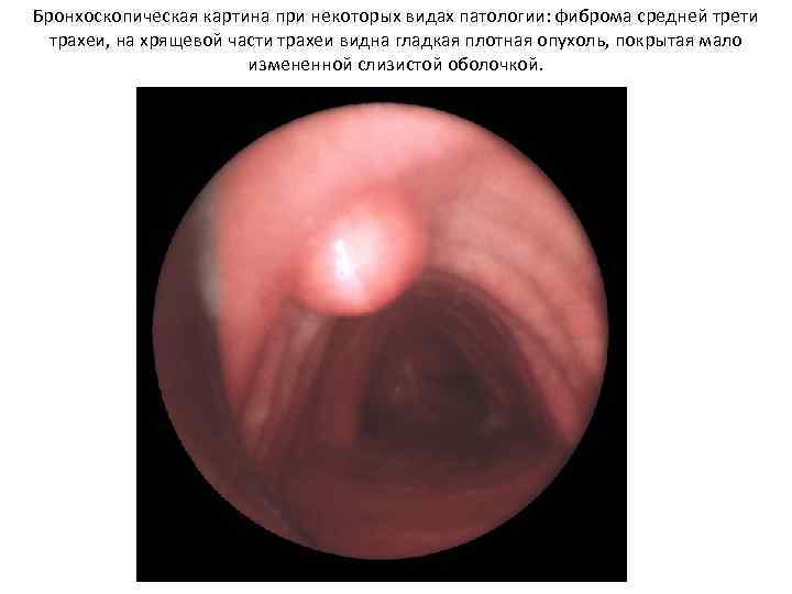 Бронхоскопическая картина при некоторых видах патологии: фиброма средней трети трахеи, на хрящевой части трахеи