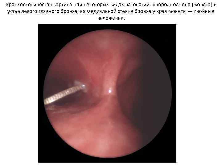 Бронхоскопическая картина при некоторых видах патологии: инородное тело (монета) в устье левого главного бронха,