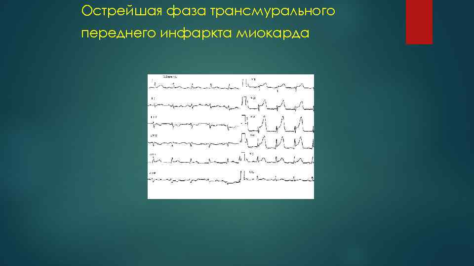 Острейшая фаза трансмурального переднего инфаркта миокарда 