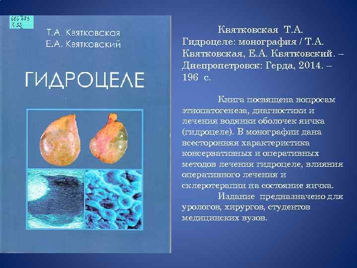 Квятковская Т. А. Гидроцеле: монография / Т. А. Квятковская, Е. А. Квятковский. – Днепропетровск: