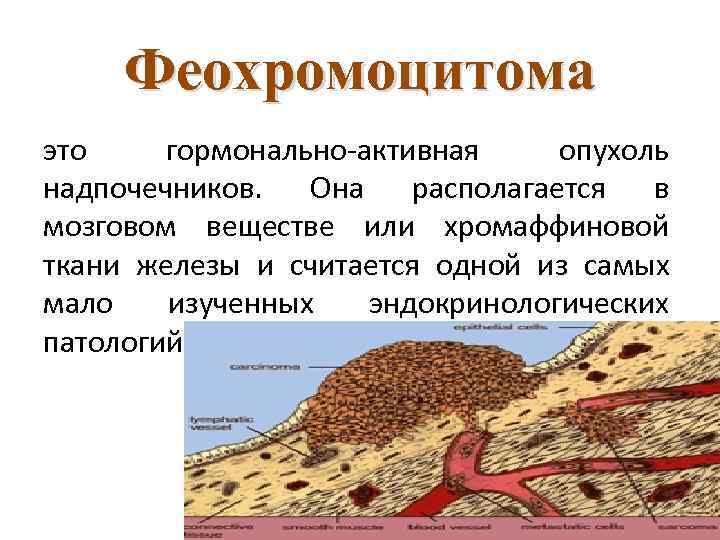 Феохромоцитома это гормонально-активная опухоль надпочечников. Она располагается в мозговом веществе или хромаффиновой ткани железы